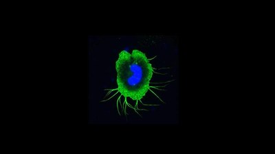 Genetic causes of immunodeficiency in microgravity